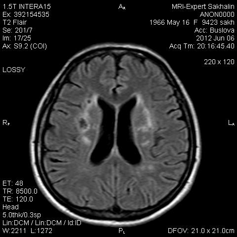 Мр картина множественных супратенториальных очагов глиоза что это