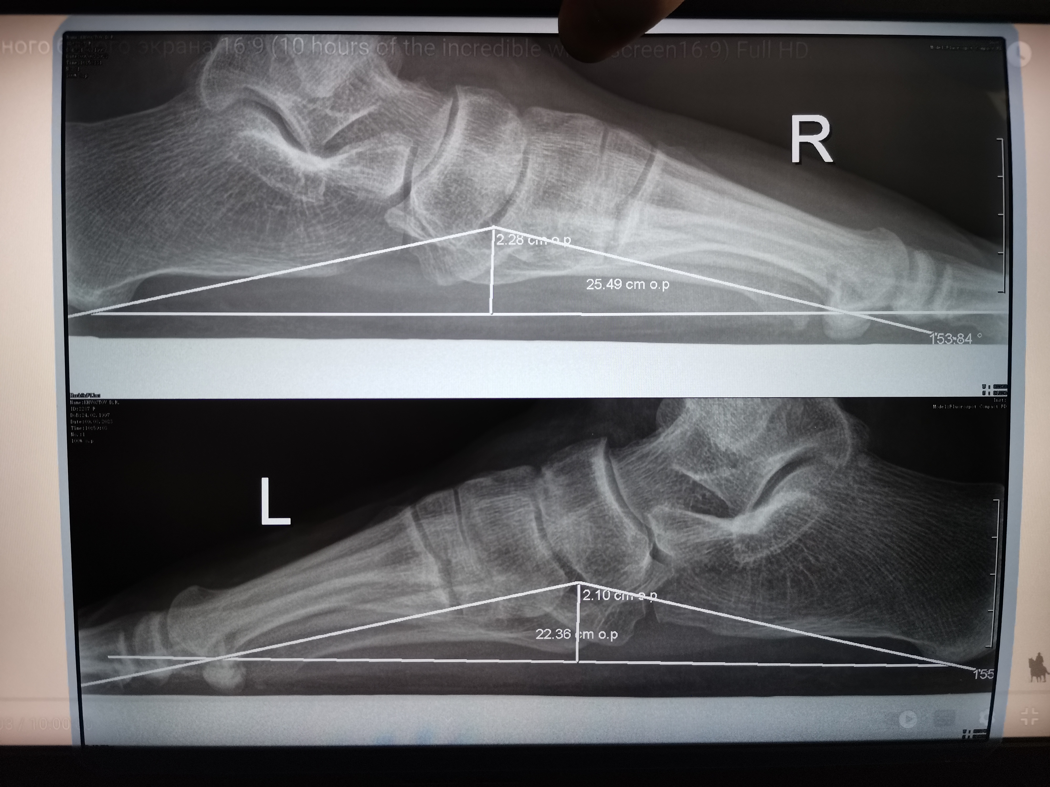 Как правильно делать рентген стоп. Рентген плоскостопия для военкомата. Плоскостопие рентген. Рентген стоп для военкомата.