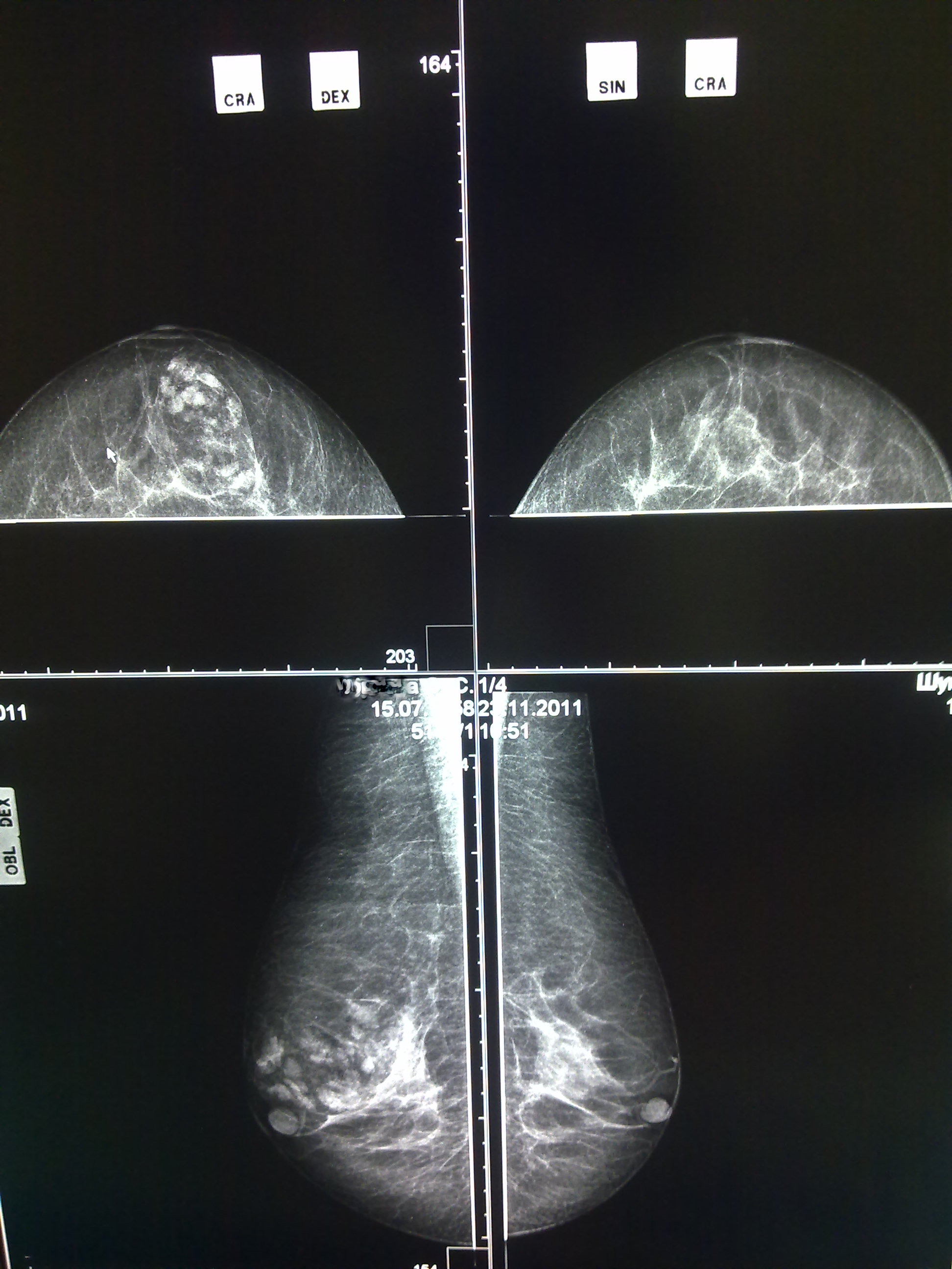 Маммография краснодар где. Маммография квадранты. Двухэнергетическая маммография. Микрокиста маммография. Билатеральная маммография.