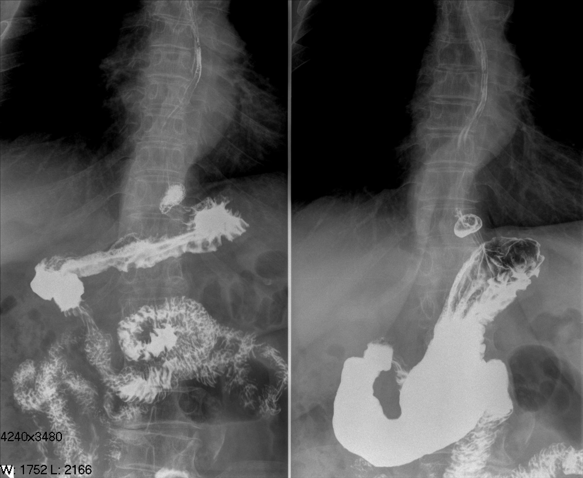 Рентгеноскопия пищевода подготовка. Рентгеноскопия желудка и двенадцатиперстной кишки. Рентгенография желудка с барием. Рентгеноскопическое исследование желудка.