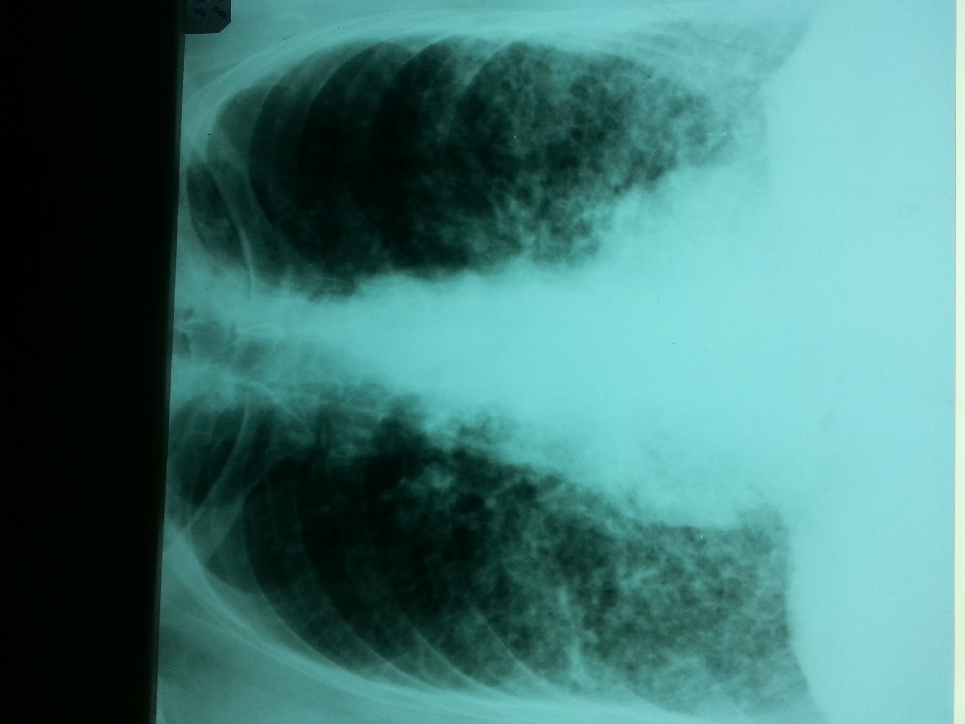 Как лечить диффузный пневмосклероз легких