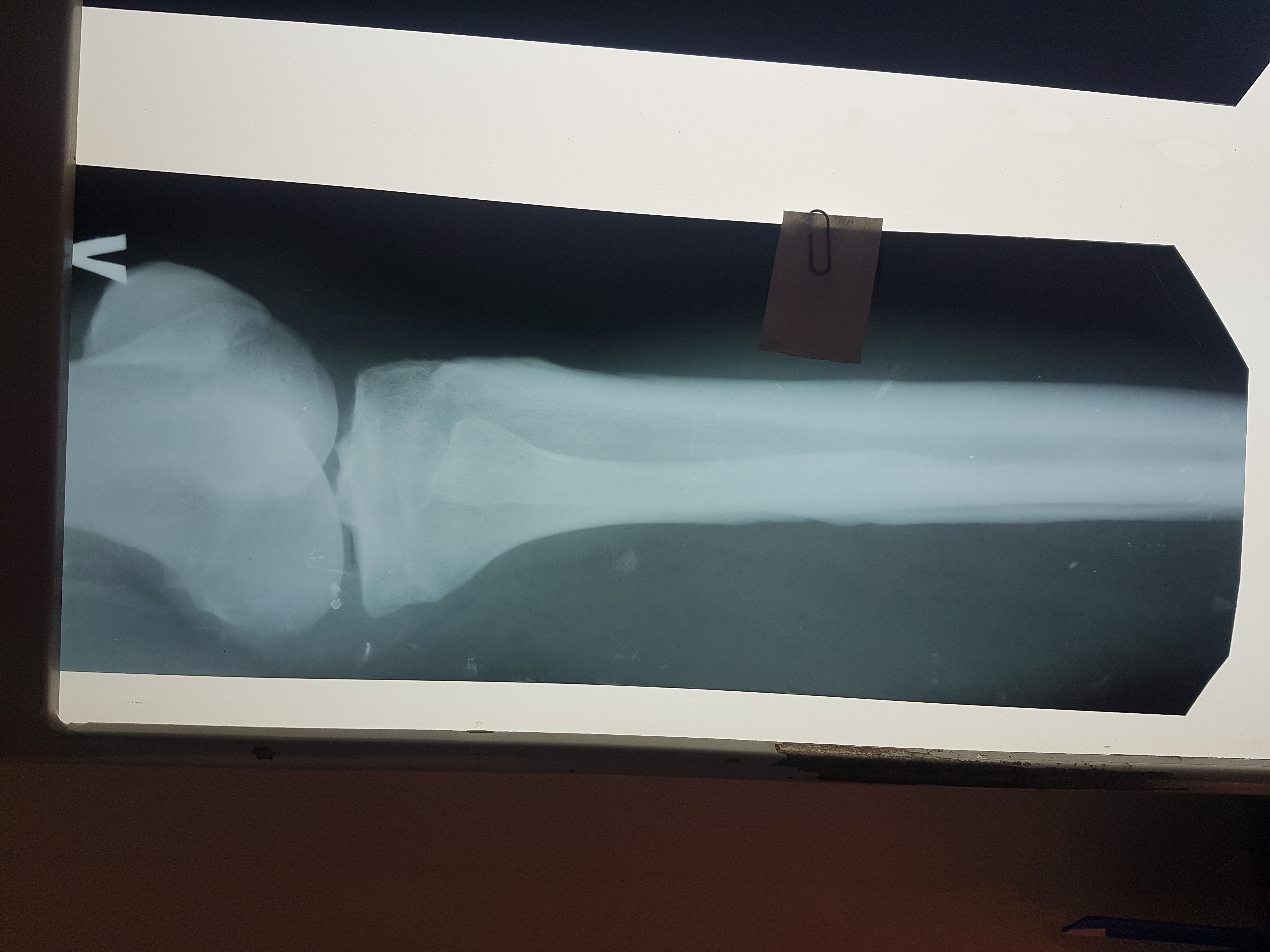 Рентген берцовой кости