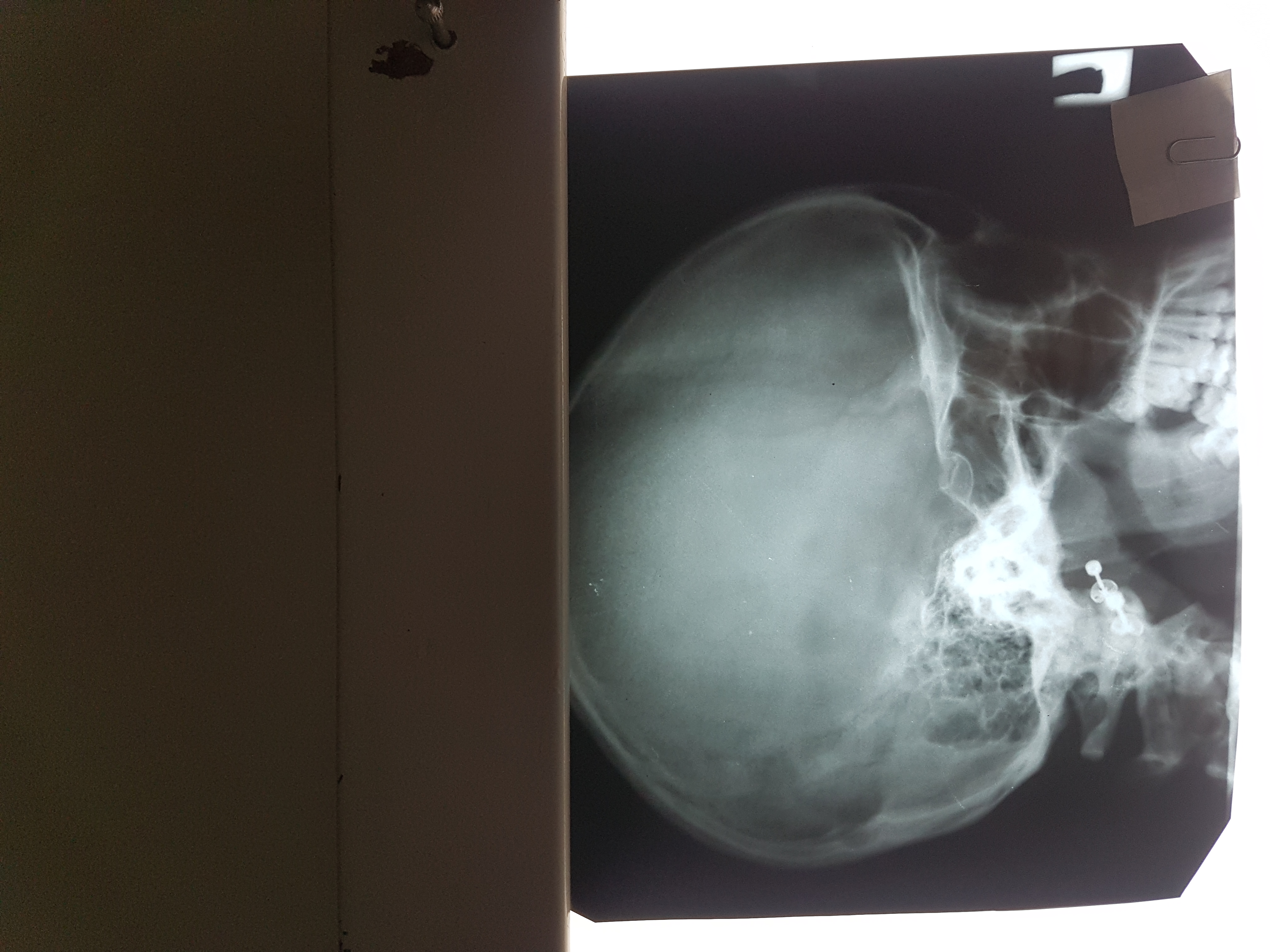 Рентген черепа турецкое седло