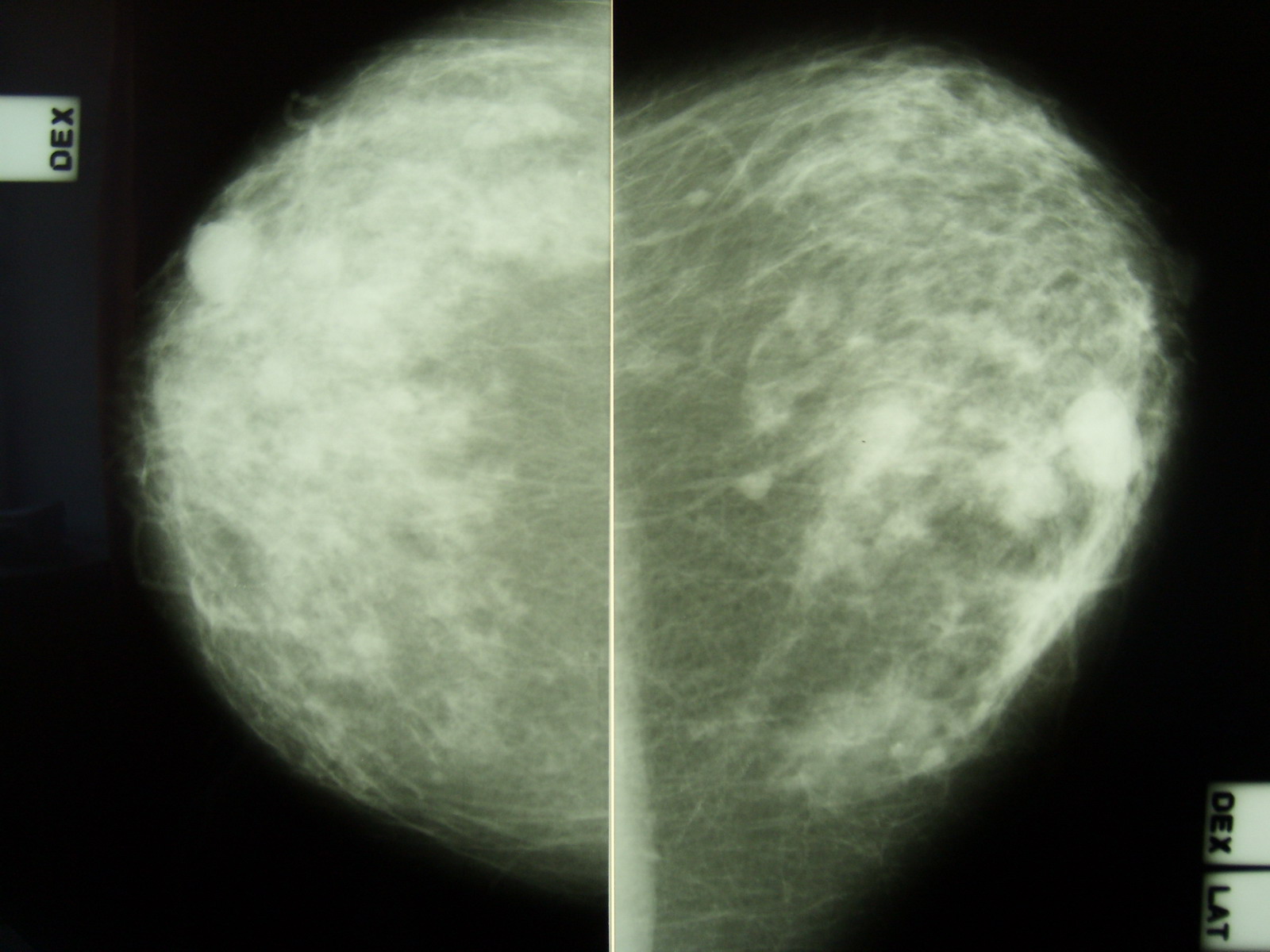 Хвост кометы маммография