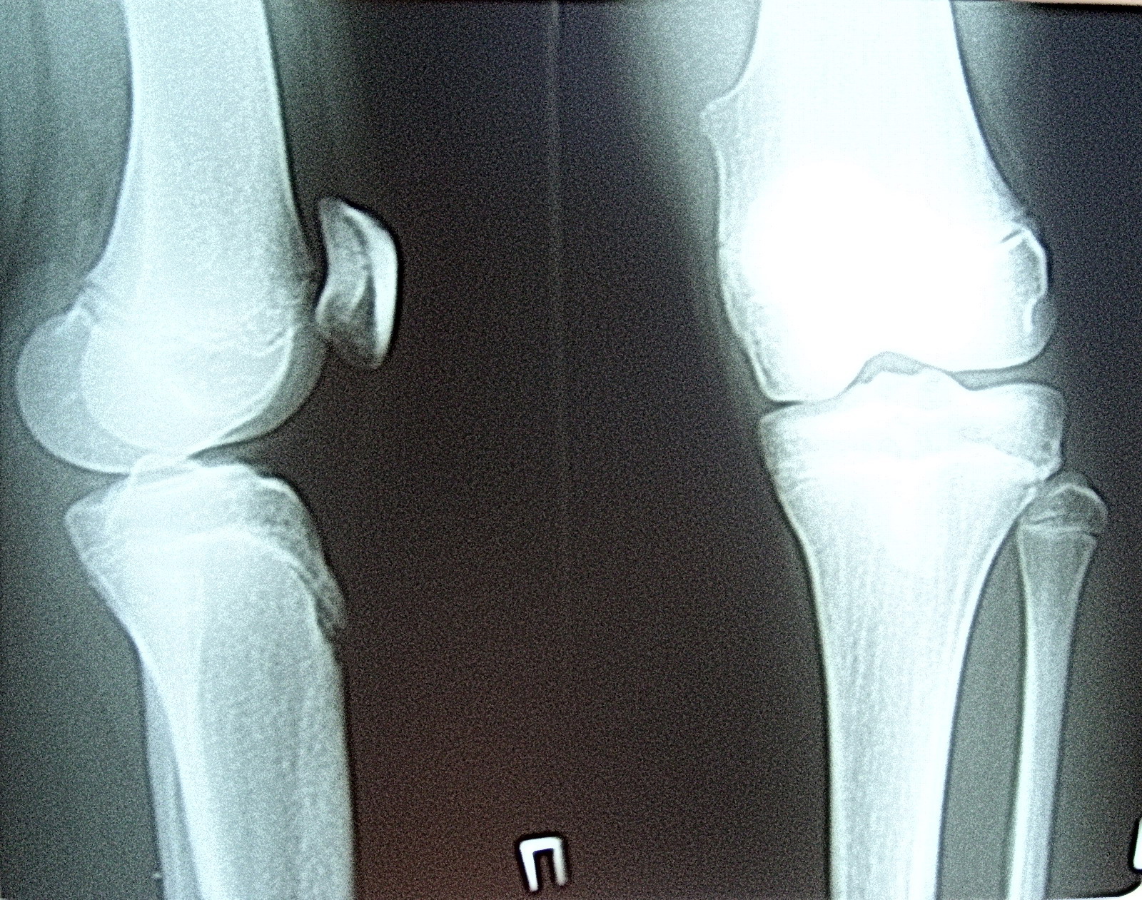 Фото здорового коленного сустава человека рентген