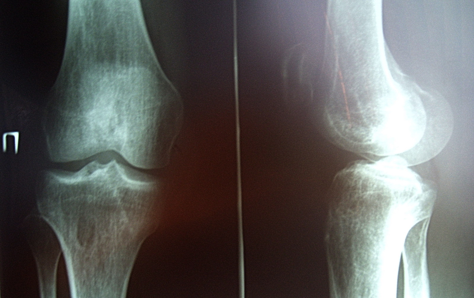Трещина в суставе. Перелом мыщелка коленного сустава. Коленный мыщелок перелом. Вколоченный перелом коленного сустава. Мыщелки коленного сустава перелом.