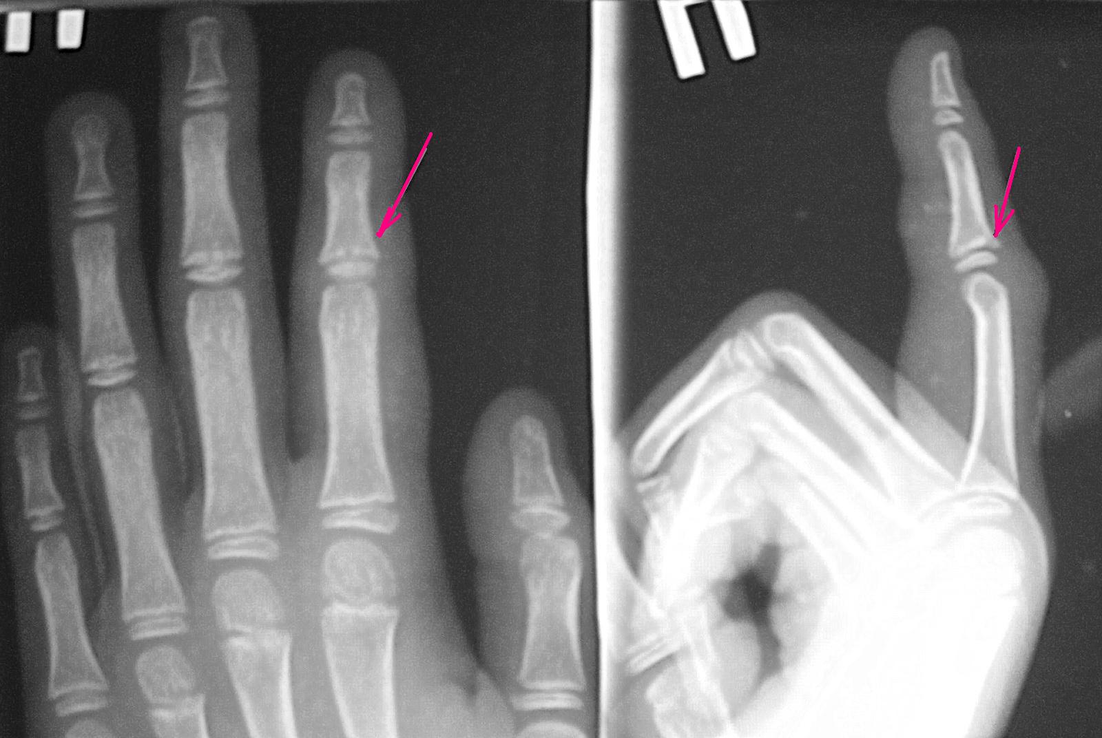 Перелом указательного пальца рентген