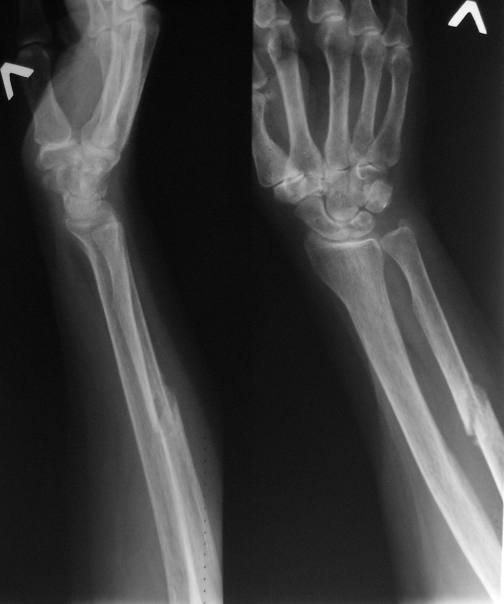 Лучевая кость на руке трещина фото