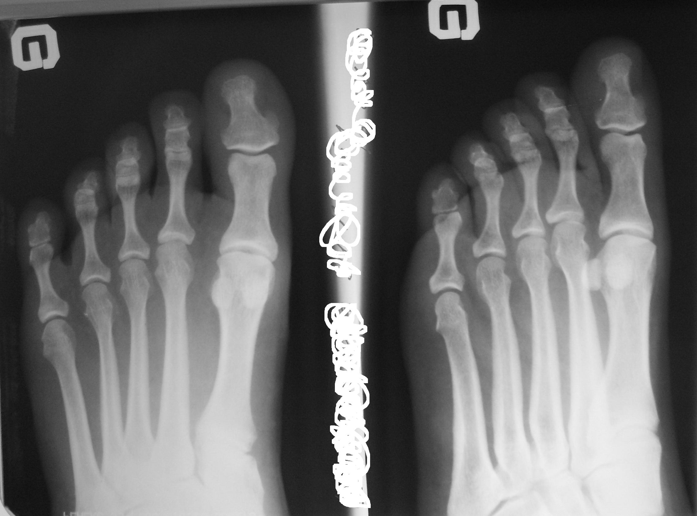 Ногтевая фаланга стопы. Остеохондрома ногтевой фаланги 1 пальца стопы. Перелом дистальной фаланги 1 пальца стопы рентген. Перелом 1 пальца стопы на рентгене. Перелом диафиза проксимальной фаланги.