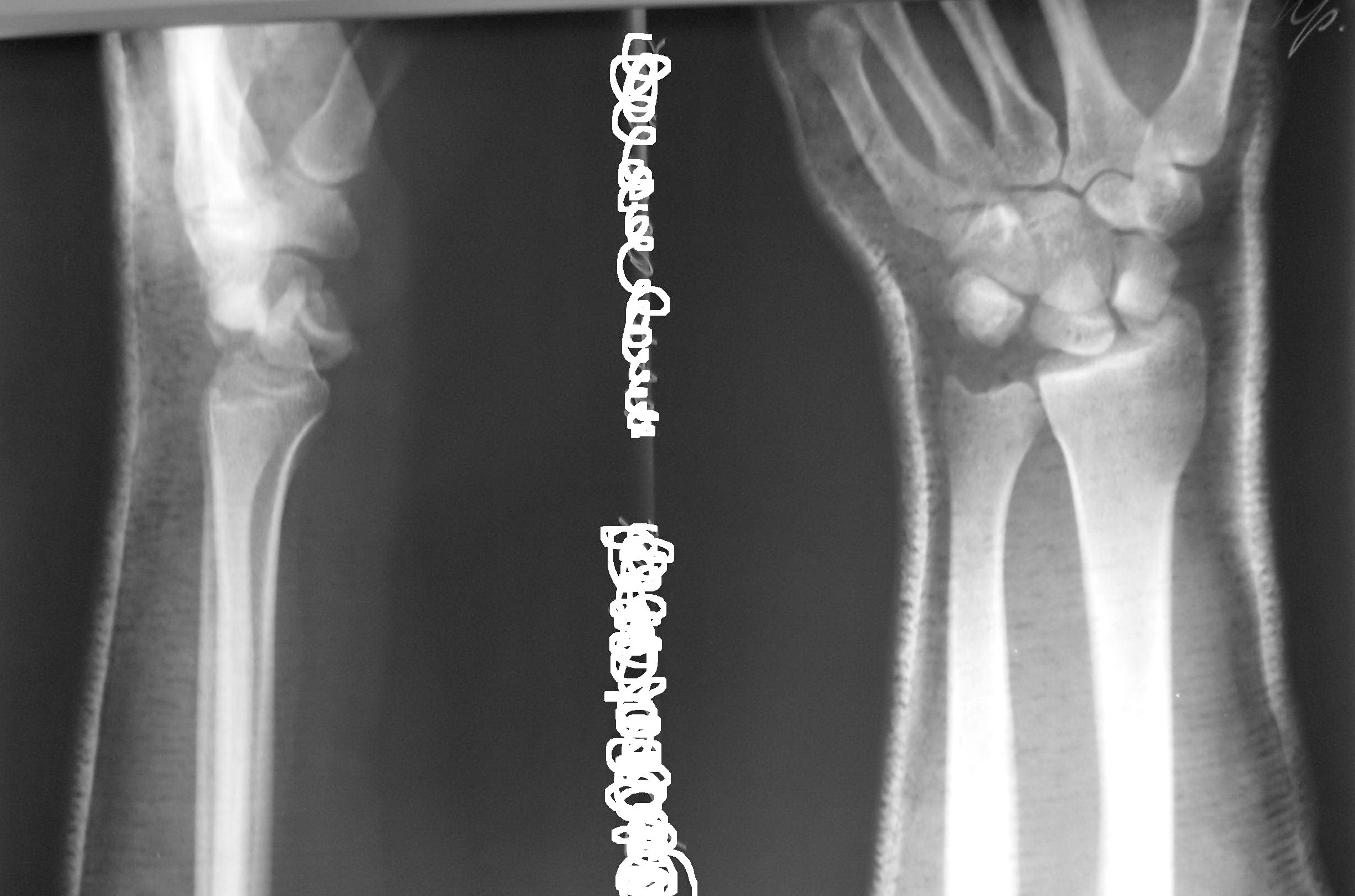 Перелом шиловидного отростка лучевой кости рентген