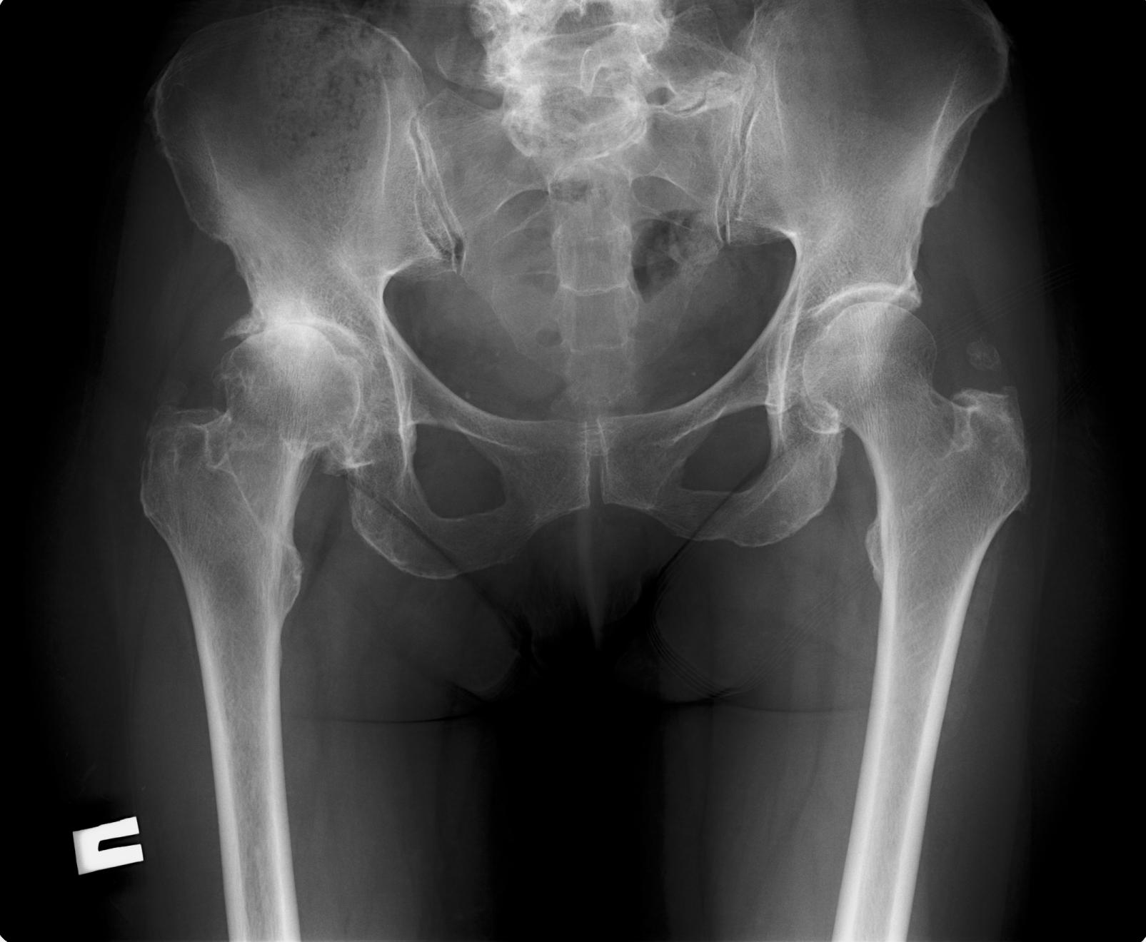 Что такое тбс. Обызвествления тазобедренного сустава рентген. Метастазы костей таза рентген. Остеопороз костей таза костей рентген.