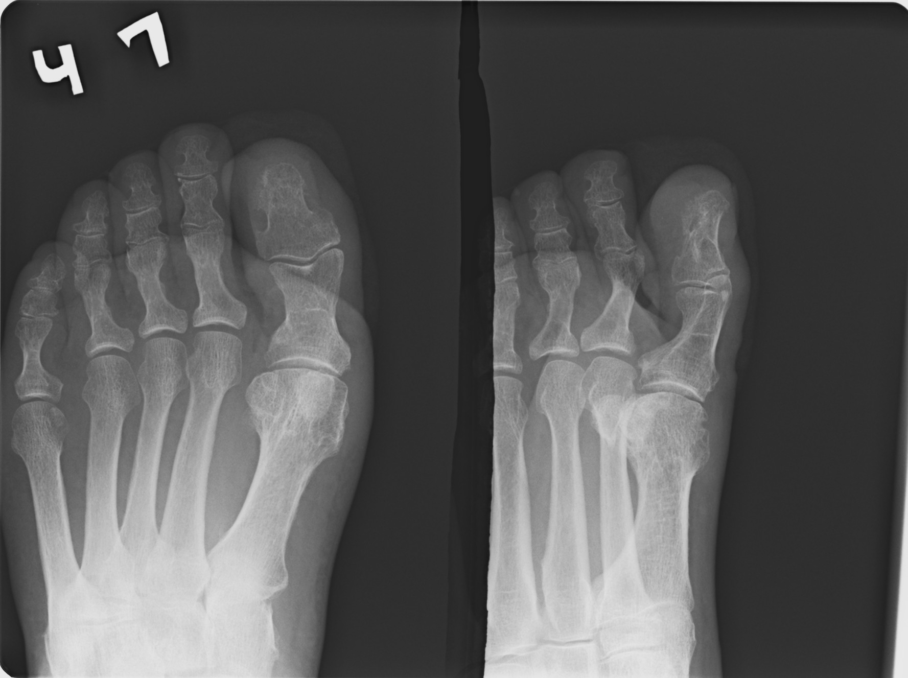 Ногтевой фаланги пальца ноги. Остеомиелит 1 плюсневой кости. Остеомиелит ногтевой фаланги 1 пальца стопы. Остеомиелит пальцев стопы рентген. Остеомиелит фаланги пальца рентген.