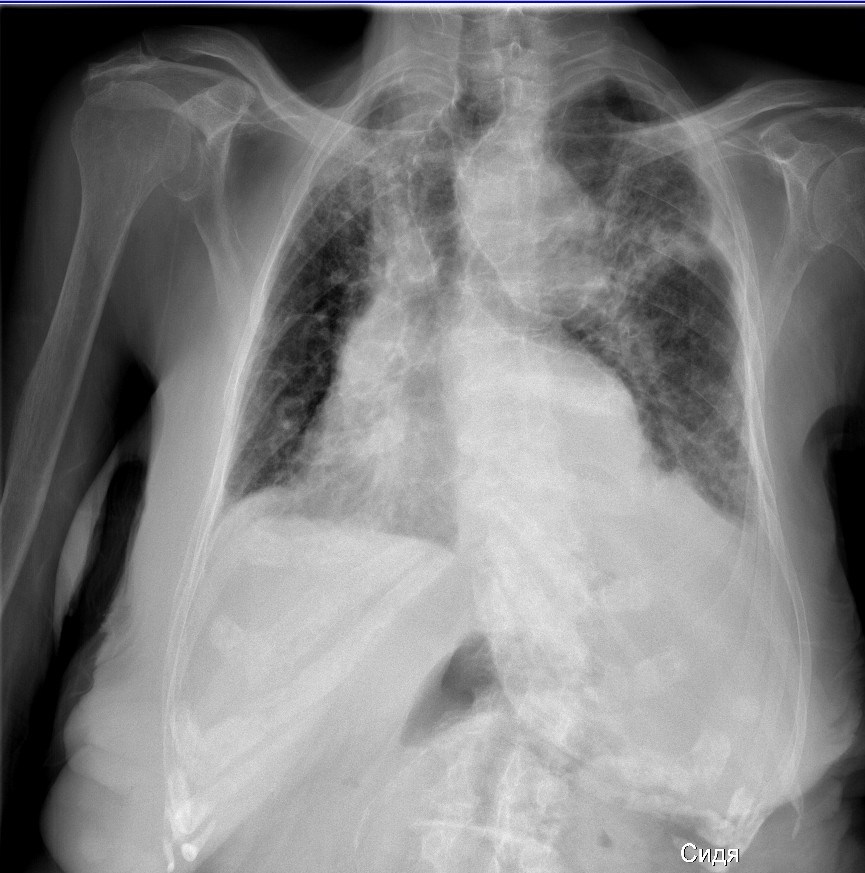 Рентген огк. ОГК пневмония. Цифровая рентген ОГК. Снимки ОГК при пневмонии. RG ОГК.