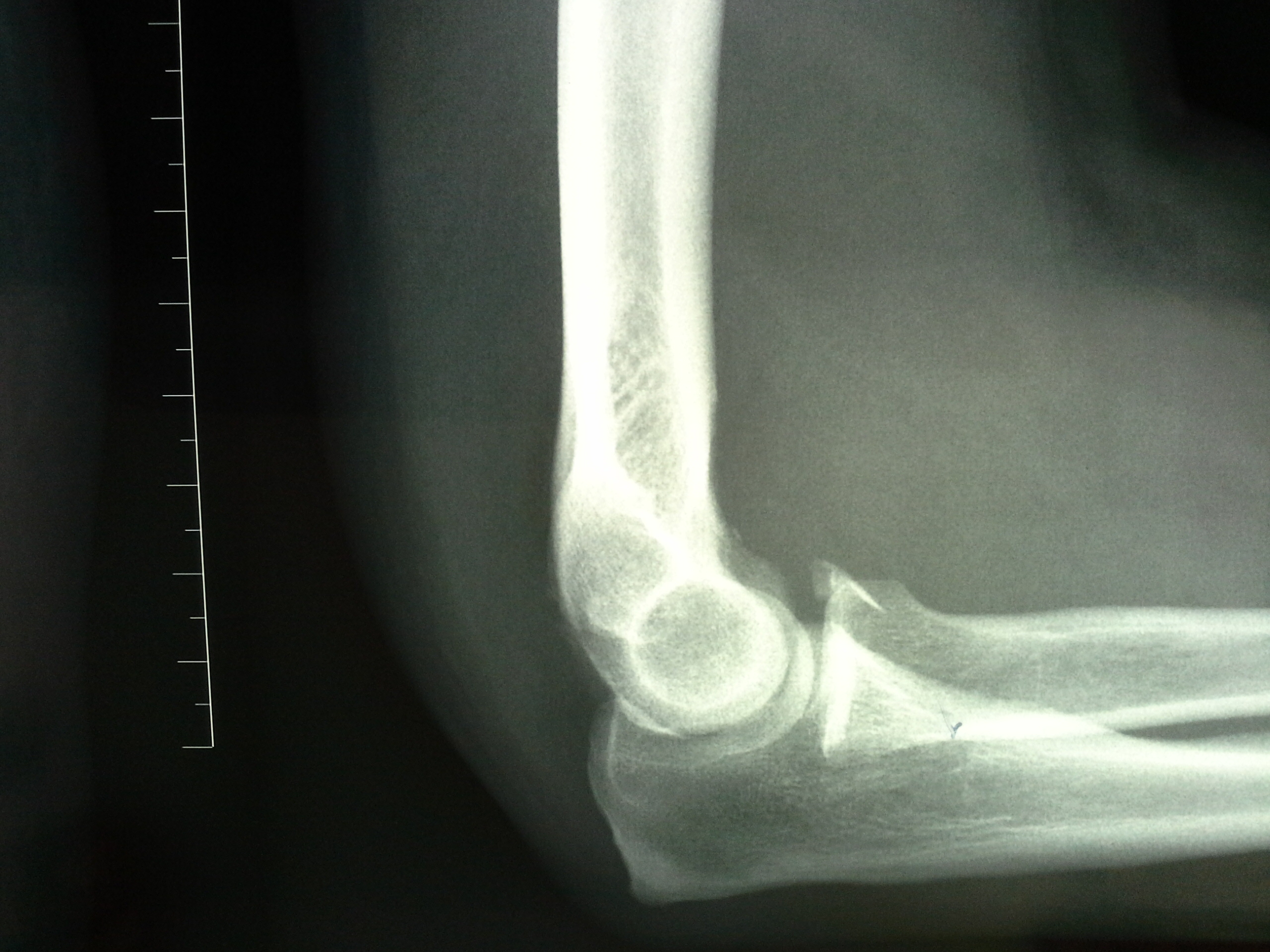 Перелом локтя. Перелом венечного отростка локтевой кости. Перелом венечного отростка рентген. Перелом венечного отростка локтевая кость. Перелом венечного отростка локтевого сустава.