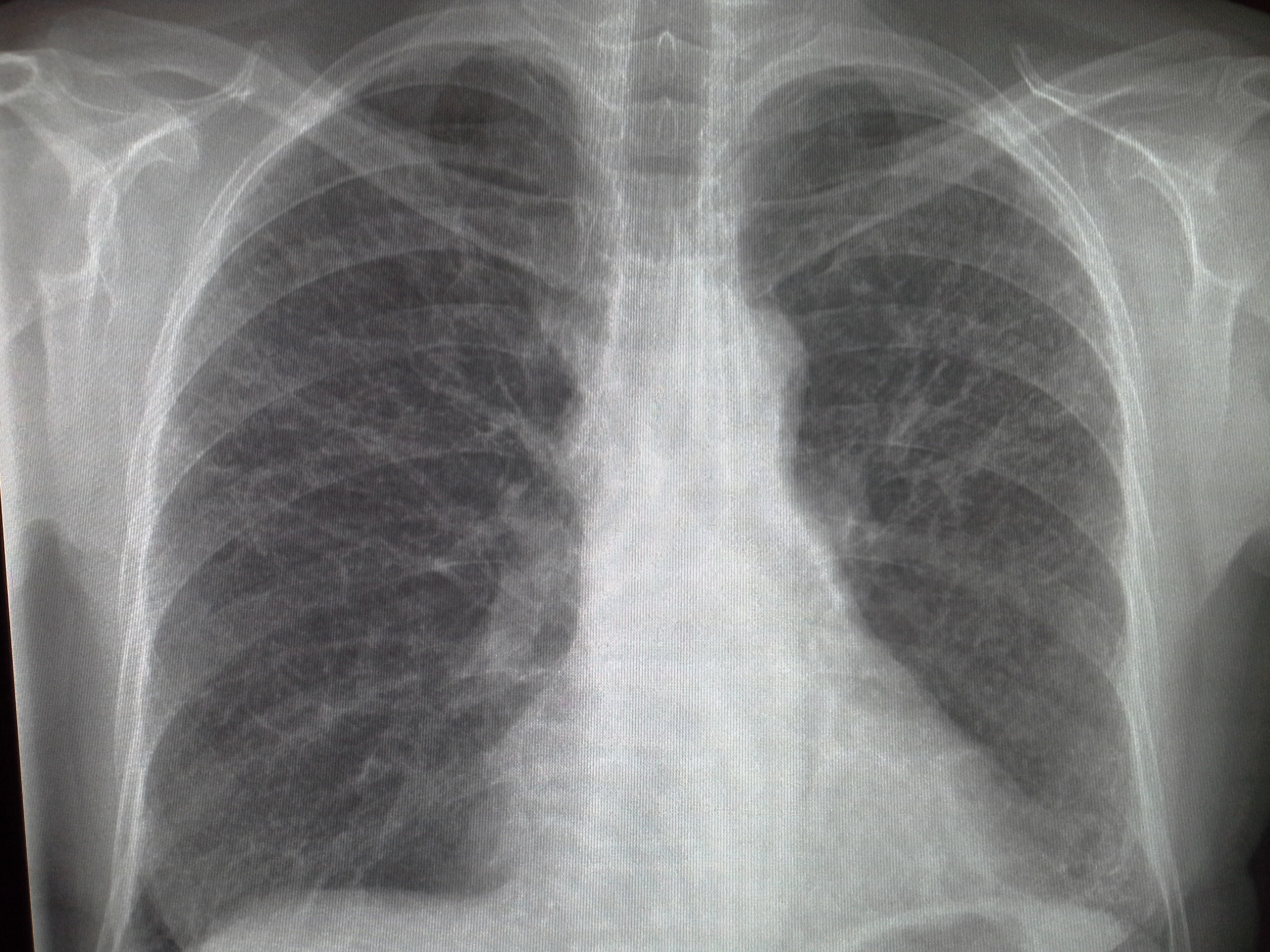 Альвеолярная пневмония рентген