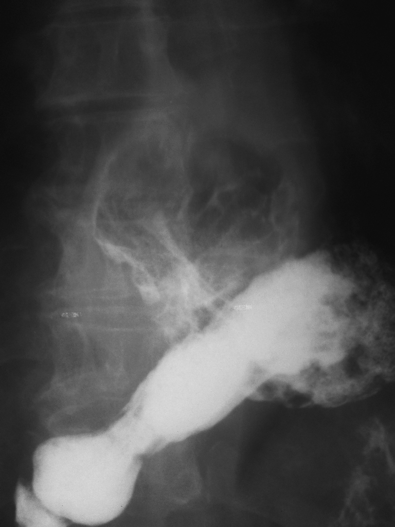 Короткий пищевод. Короткий пищевод рентгенограмма. Короткий пищевод рентген. Врожденный короткий пищевод рентген. Врожденный короткий пищевод.