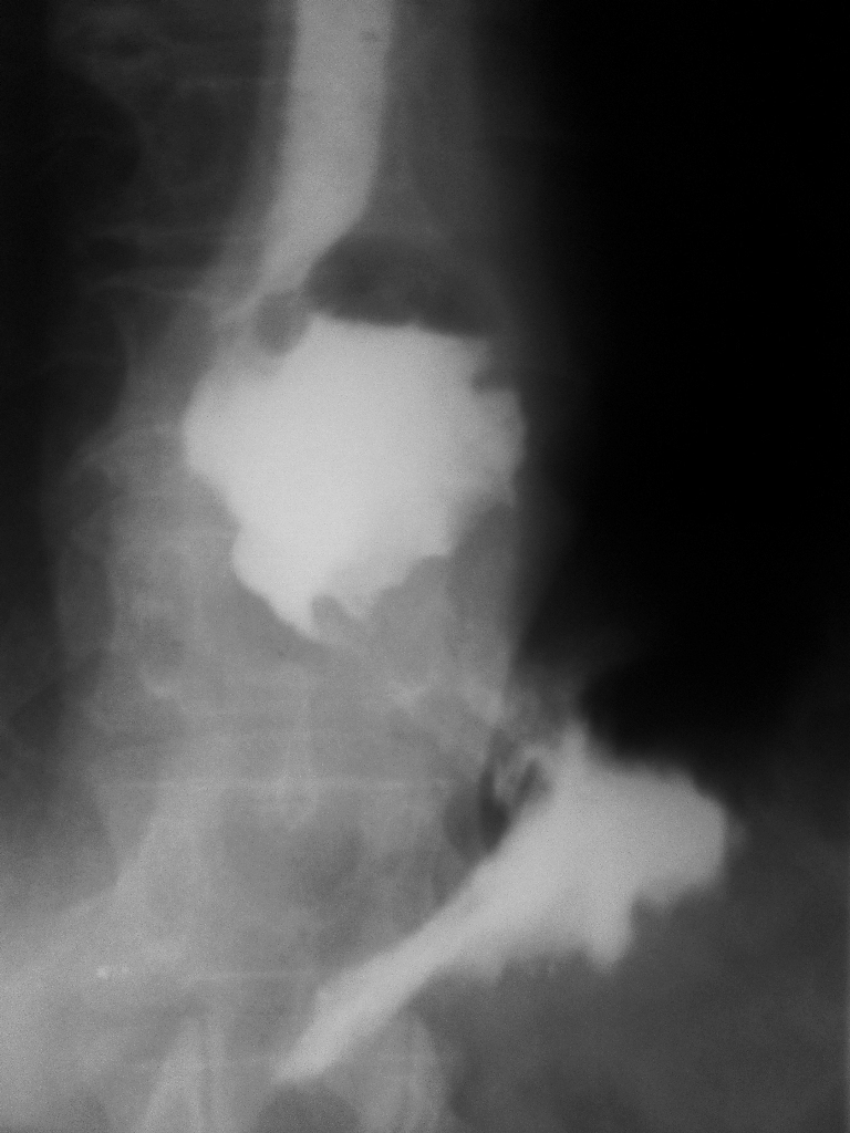 Короткий пищевод. Врожденный короткий пищевод рентген. Короткий пищевод рентгенограмма. Короткий пищевод рентген. Врожденный короткий пищевод снимок.