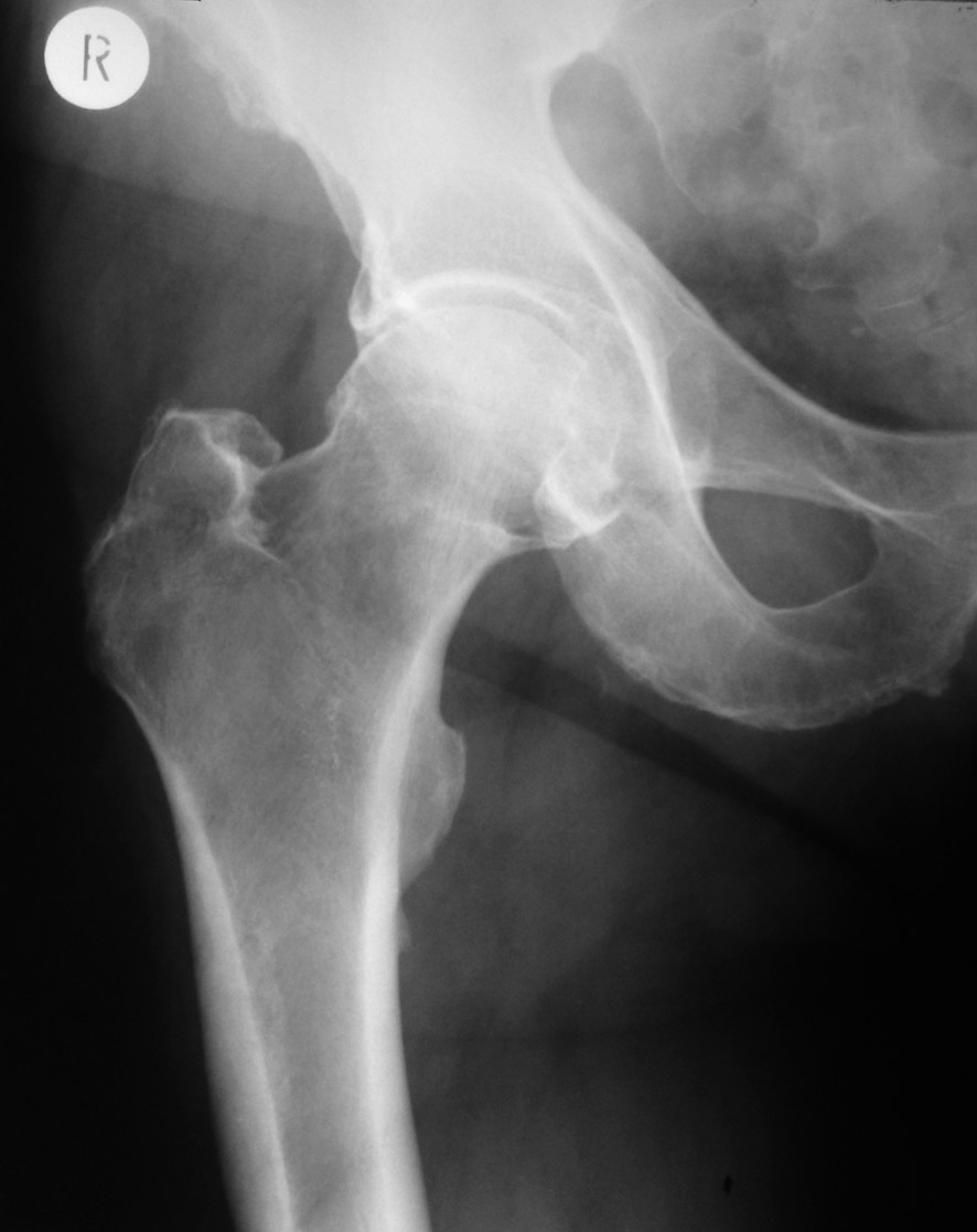 Коксартроз тазобедренного сустава 2 степени рентген фото