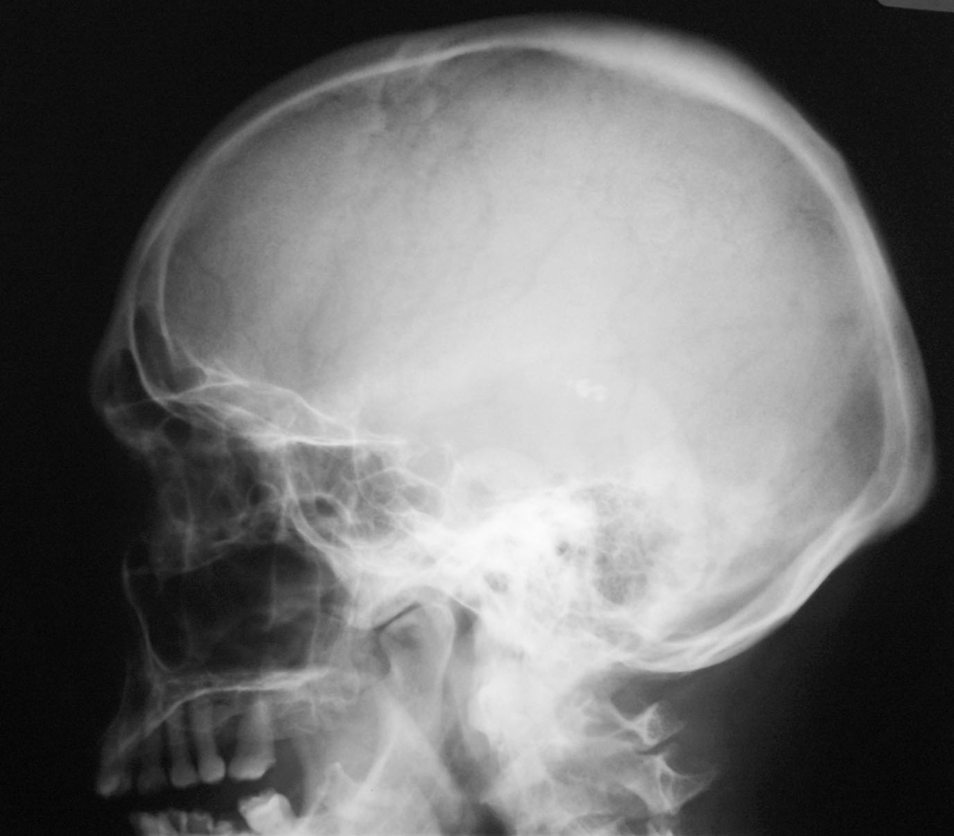 Детский череп рентген. Меланома рентген черепа. Рентгенограмма черепа 3 года.