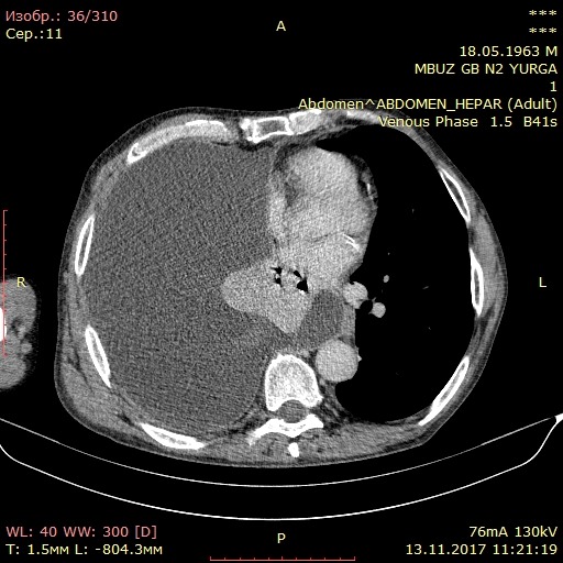 Гидроторакс на кт. Тотальный гидроторакс кт. Кт признаки гидроторакса. Гидроторакс на кт легких.