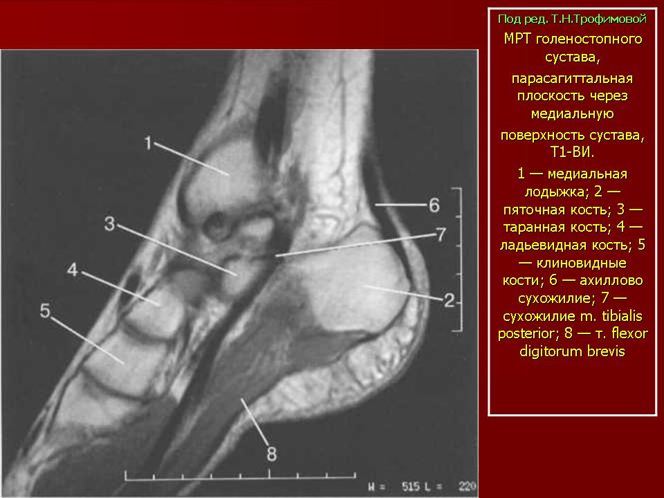 Голеностопный сустав поверхности. Пяточная кость анатомия мрт. Анатомия голеностопного сустава мрт. Кт анатомия голеностопного сустава. Рентгеноанатомия голеностопного сустава.